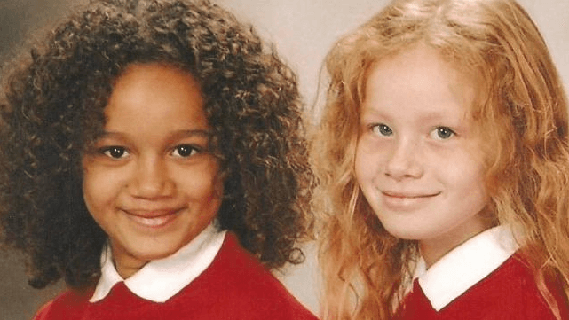 These Twins Stunned The World When They Were Born Twenty ...