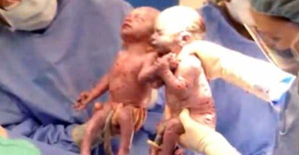 Doctor Looks Down Seconds After He Delivers Twins – What He Sees Leaves Him Stunned