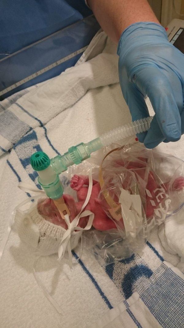 Premature Baby Spends First Weeks Of Her Life In Sandwich Bag Look At