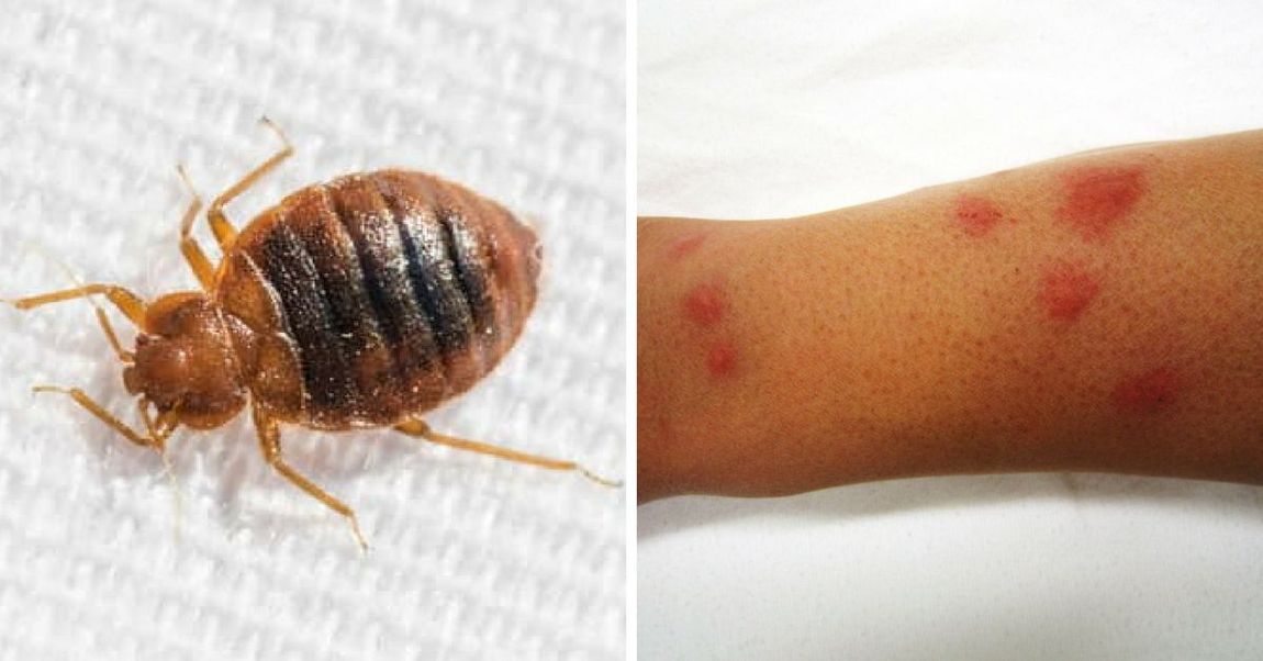 Here Are 8 Common Bug Bites And How You Can Recognize Them
