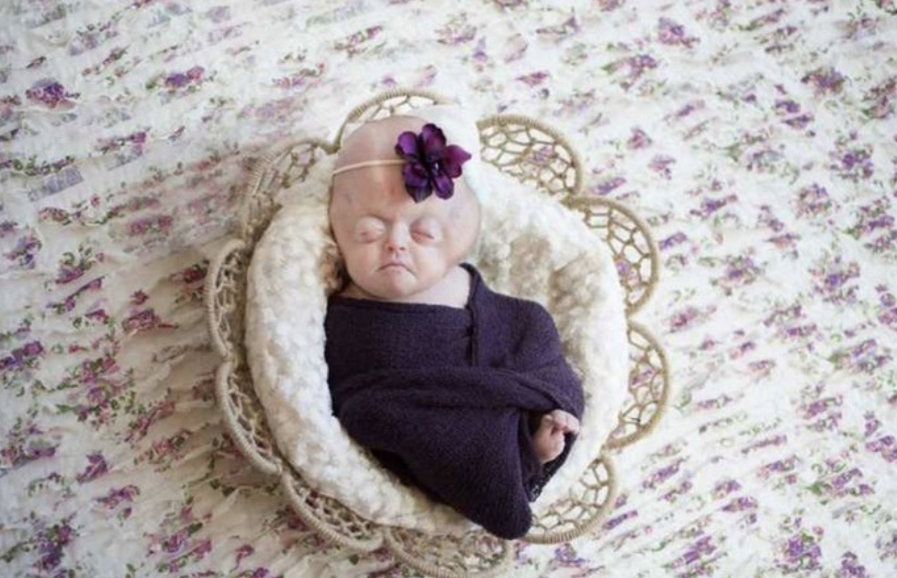 Mother Reveals What Life Is Like For Daughter With Rare Genetic ...