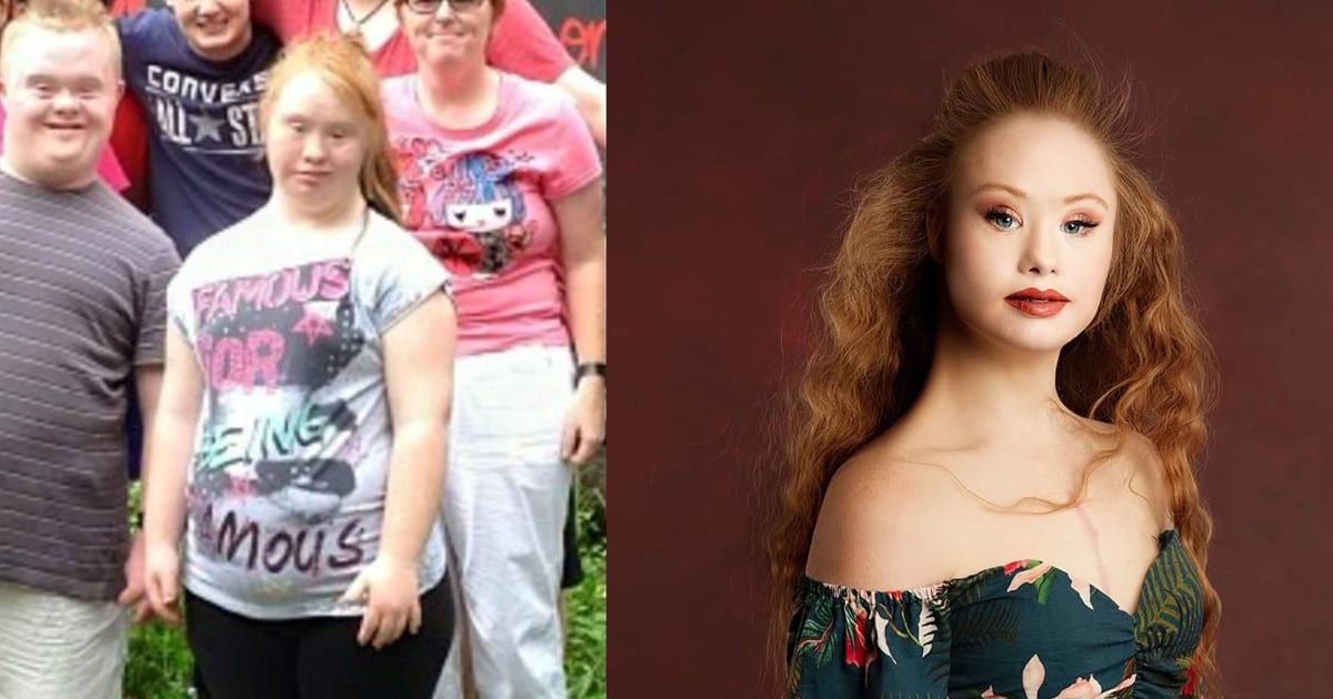 Woman With Down Syndrome Successful Model